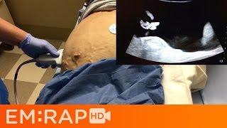 Paracentesis