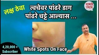 त्वचेवर पांढरे डाग, चट्टे आले तर ! Get Rid of White Spots | Pandhare Daag Chatte | Skin problem