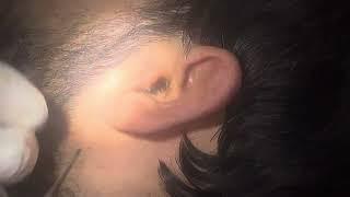 Accumulated Nasty Wax in Ears causing hearing problems and irritation,ear cleaning done efficiently.