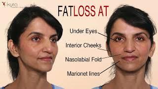 Fat Transfer to Face in Ludhiana, Punjab | Facial Transformation