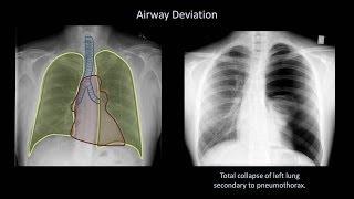 How to Interpret a Chest X-Ray (Lesson 4 - Airways, Bones, and Soft Tissues)