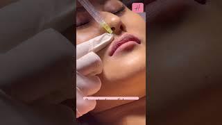 Improved Lip Shape by Fillers Live Procedure | #shorts #shortsfeed #lipfiller