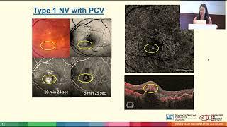 AIOC2024  GP49 Topic  Dr Anna TAN Clinical application for OCTA in AMD