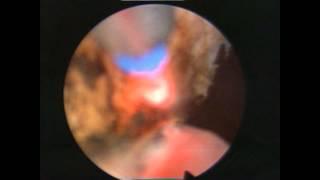 Simultaneous Thulep and hernioplasty. Dr. Farid Gadimaliyev, Customs Hospital, Baku, Azerbaijan