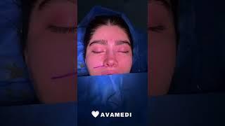 Open Rhinoplasty surgery in Iran 2023 - AvaMedi 01