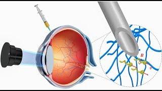 Nanorobots propel through the eye