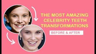 The Most Amazing Celebrity Teeth Transformations