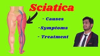Sciatica - causes, symptoms, treatment, L4-L5, L5 -S1 disc prolapse,Sciatica Stretches & Exercises