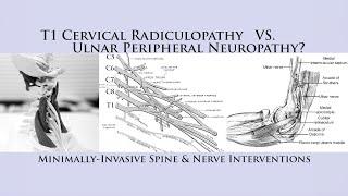 How to Differentiate T1 Cervical Radiculopathy vs Ulnar Nerve Neuropathy Cubital Tunnel Syndrome