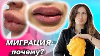 Миграция филлера в губах,почему возникает и как избежать? #губы #миграцияфиллера #косметолог #филлер