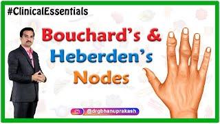 Bouchard’s and Heberden’s nodes : Clinical essentials : Dr G Bhanu Prakash