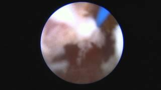 Laser urethrotomy after failed urethral dilation. Dr. Farid Gadimaliyev, Customs Hospital, Baku