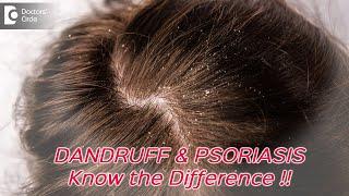 Difference between dandruff and psoriasis - Dr. Divya Sharma  | Doctors' Circle