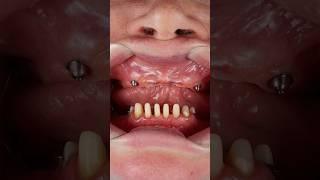 Удалили все верхние зубы.All-on-4. #allon4dentalimplants #зубныеимпланты #имплантациязубов #dentist