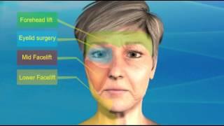 Facelift Guide