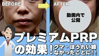 【若返りの万能注射PRP】安心して受けるための基礎知識