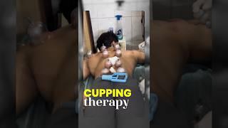 Cupping Therapy Cost  & Benefits ‍↕️