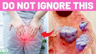 10 Critical Colon Cancer Symptoms You Should Never Ignore