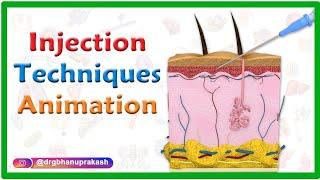 Injection Techniques Animation : Intradermal, Intramuscular, Subcutaneous and Z track