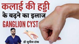 कलाई की हड्डी का बढ़ना | Effective physiotherapy exercises for wrist ganglion cysts | Dr Sunil Tank