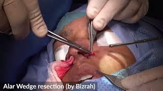 Alar Wedge Resection-26: Rhinoplasty Bizrah- London/ Dubai- Dr. Bashar Bizrah