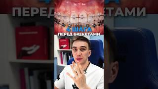 4 шага перед брекетами