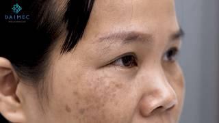 Điều Trị Miễn Phí Các Bệnh Lý Về Bớt Sắc Tố Cho Những Hoàn Cảnh Đặc Biệt - Viện Thẩm Mỹ Daimec
