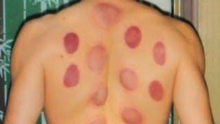 What You Need to Know About Cupping