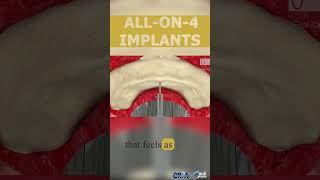 All-on-4 Implants: A New Smile in Just One Day!