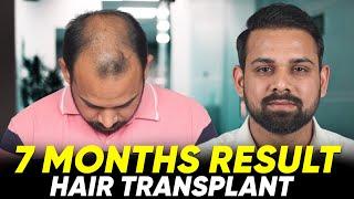 Hair Transplant in Salem | Best Results & Cost of Hair Transplant in Salem