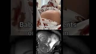 9 Months Pregnancy Baby Movement Inside Belly