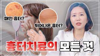 흉터 치료, 고민만 하셨나요? 이 영상으로 모든 흉터 고민 해결 끝!(다양한 흉터 모양에 따른 치료방법)ㅣ은혜로운 의사생활