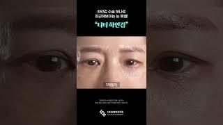 자연스럽게 젊어지는 중년 하안검 수술