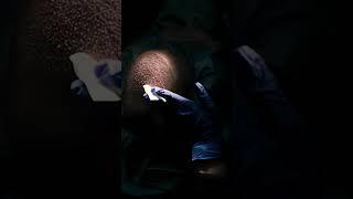 Transplante Capilar .Care4Hair