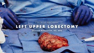 Video-Assisted Thorascopic Left Upper Lobectomy by Shanda Blackmon, MD | Preview