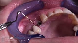 Single Implant Placement Maxillary First Bicuspid - Implant Course