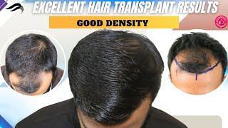 Hair Transplant In Salem | Best Cost Clinic Surgeon & Results Of Hair Transplant In Salem