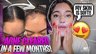 HOW I FULLY CLEARED MY ACNE! *MY EVERY DAY SKIN CARE ROUTINE*