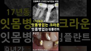 잇몸병 없는 크라운. 잇몸병 없는 임플란트. 지르코니아 나사유지형 임플란트 안하니까 잇몸뼈파괴없음. 브리지제거시 김문수스타일. 크라운수명 임플란트수명 59세치아 2025_05_14