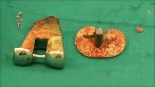 Management of periprosthetic joint infection and making a knee spacer