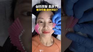 팔자주름 실리프팅으로 가능할까? #팔자주름 #시술 효과