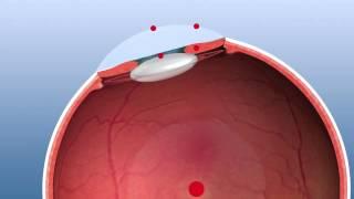 SCHWIND Amaris 500E with 5D Eyetracking - Audio Version