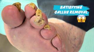 A HOLIDAY FOOT CLEANUP! / SATISFYING CALLUS REMOVAL