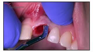 Immediate Implant Placement V3 MIS - Comp.Guided Surgery, Allograft, Mucoderm(Botiss)