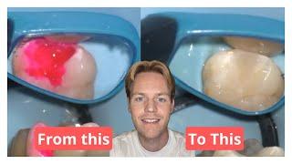 Replacing an Old Composite Filling: Step-by-Step Dental Restoration Explained!