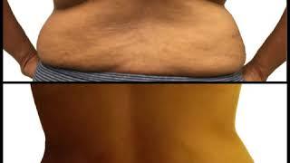 52 year old patient receives liposuction of the love handles (lower back)