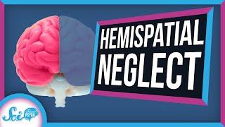 Hemispatial Neglect: When Half Your World Disappears