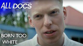 What It's Like To Have Albinism in Tanzania | Full Documentary | All Documentary