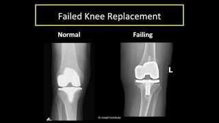 Knee Replacement Revision: Why, How and What to Expect