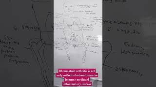 rheumatoid arthritis #RA#rheumatoidarthritis#arthritis